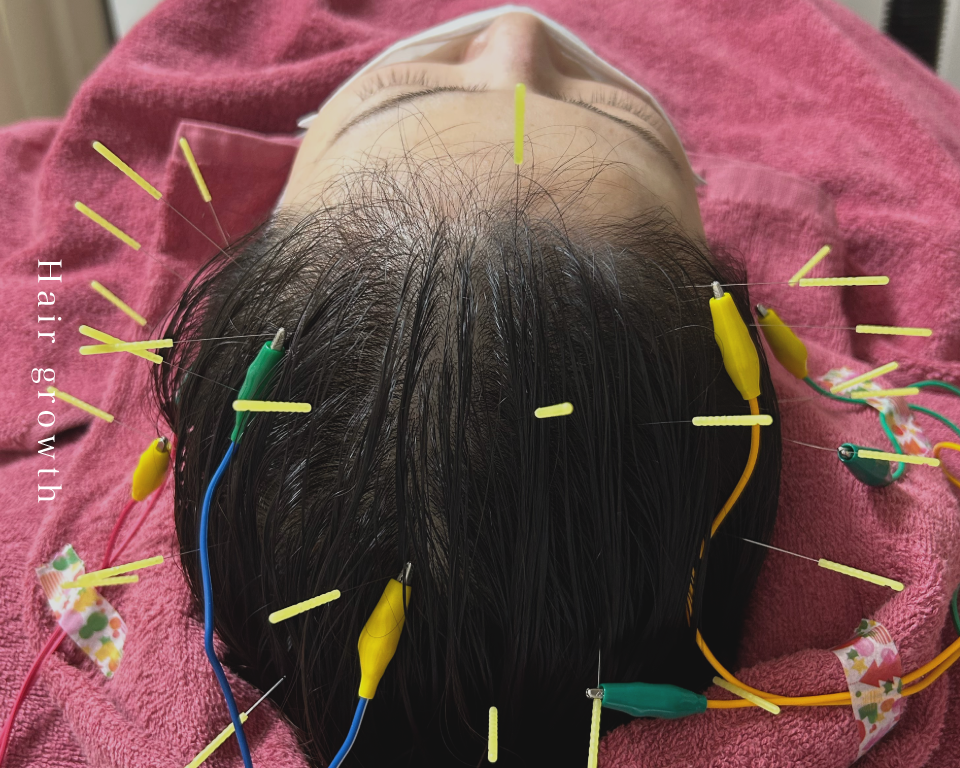梅田・西天満の鍼灸院・美容鍼灸サロン【プティ・エシェル】の育毛鍼の施術写真