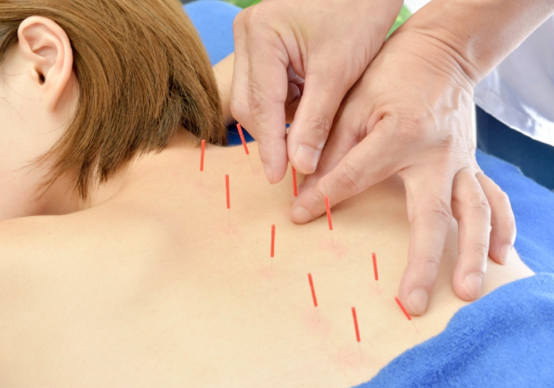 身体ケア鍼灸「背面コース」