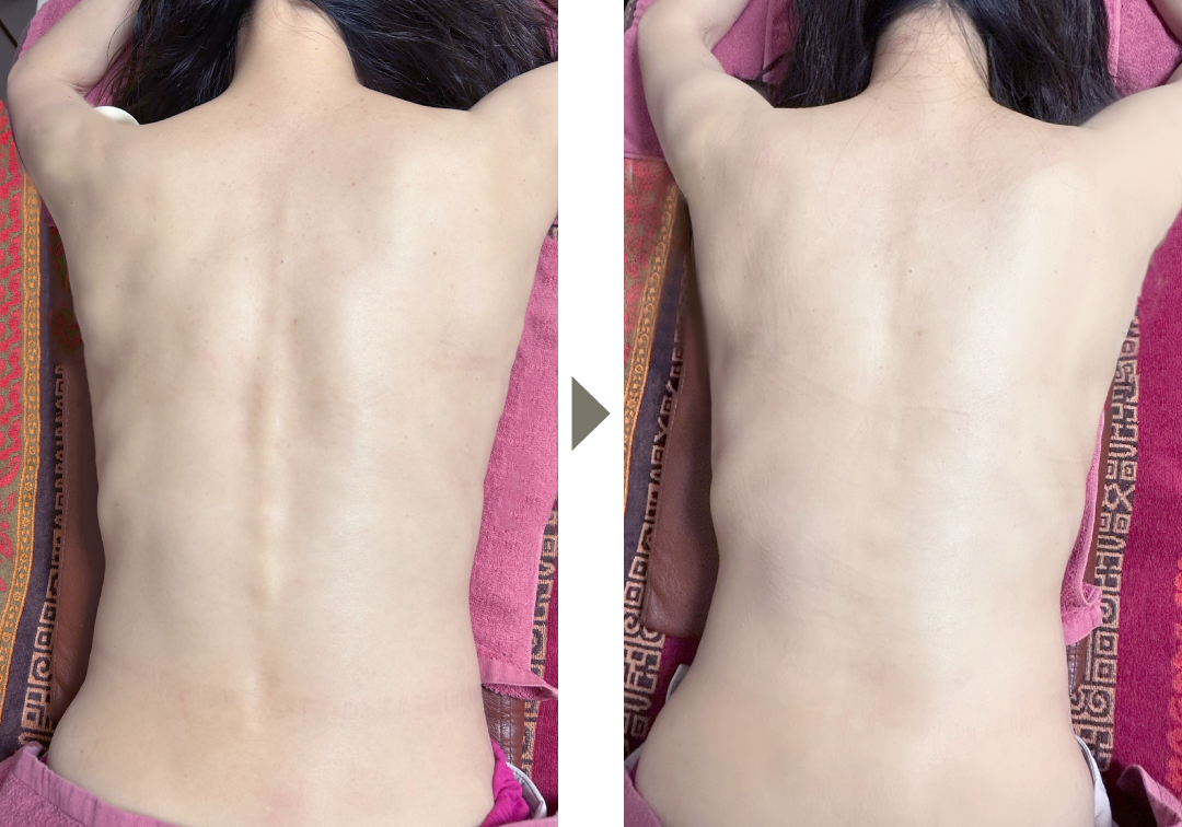 身体ケア鍼灸全身コース（背面・前面）