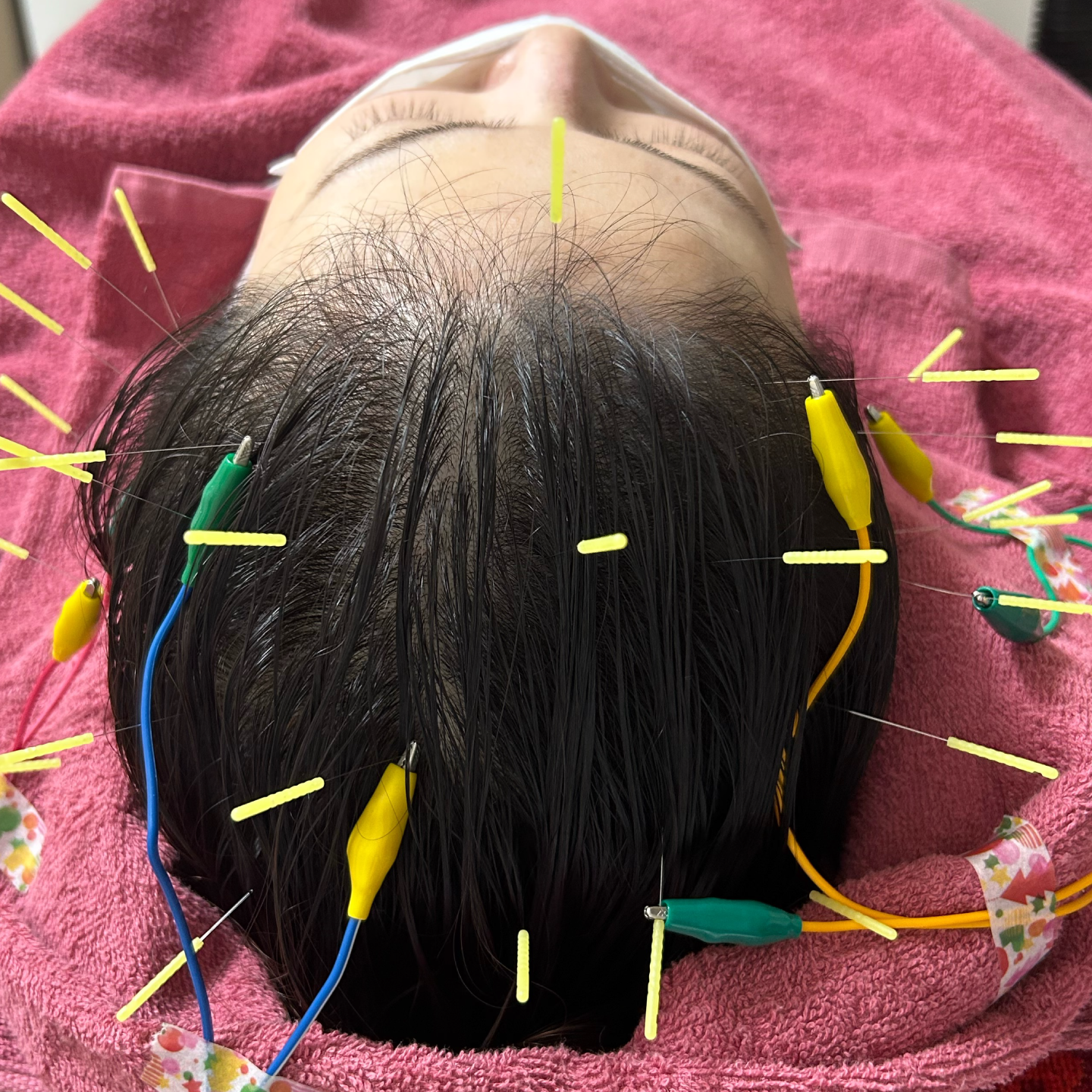 育毛鍼の施術写真