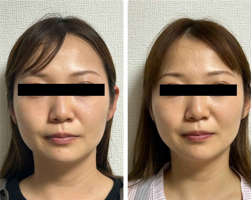 美容鍼・小顔矯正のビフォアー・アフターNO.2