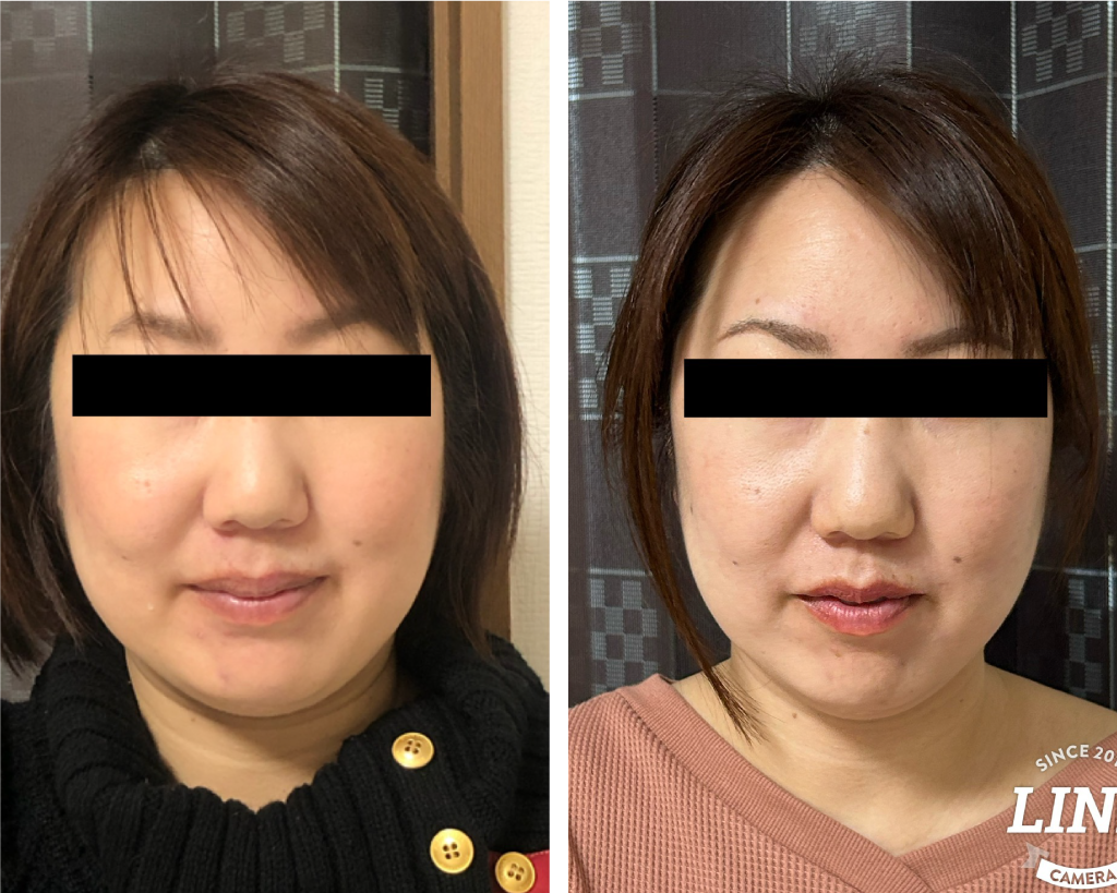 美容鍼・小顔矯正のビフォアー・アフターNO.3