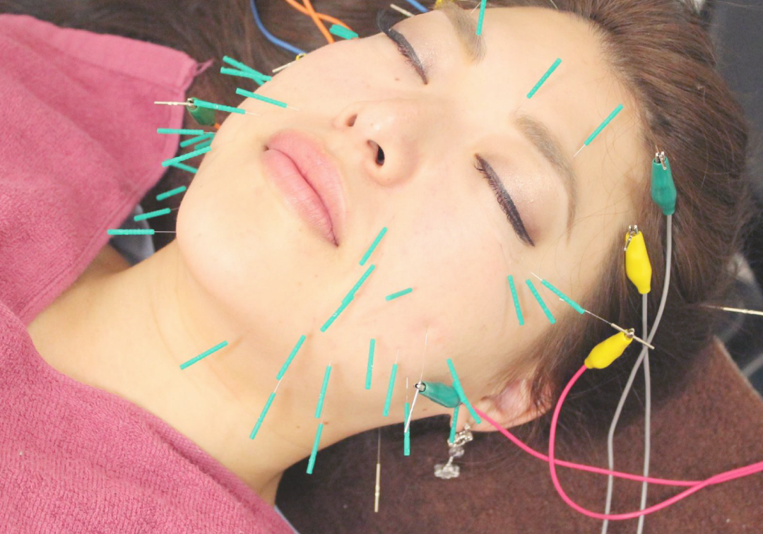 美容鍼・小顔矯正「ハリレイガンb整形疑惑コース」